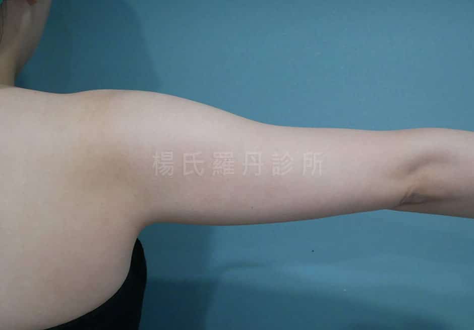 手臂抽脂 手臂抽脂推薦