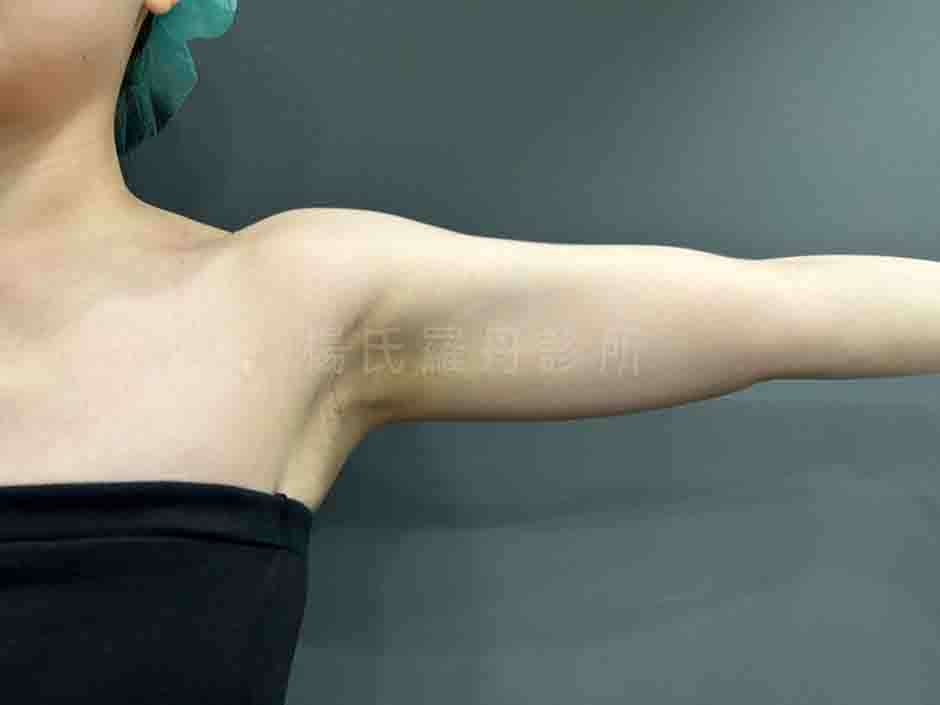 手臂抽脂 雕塑