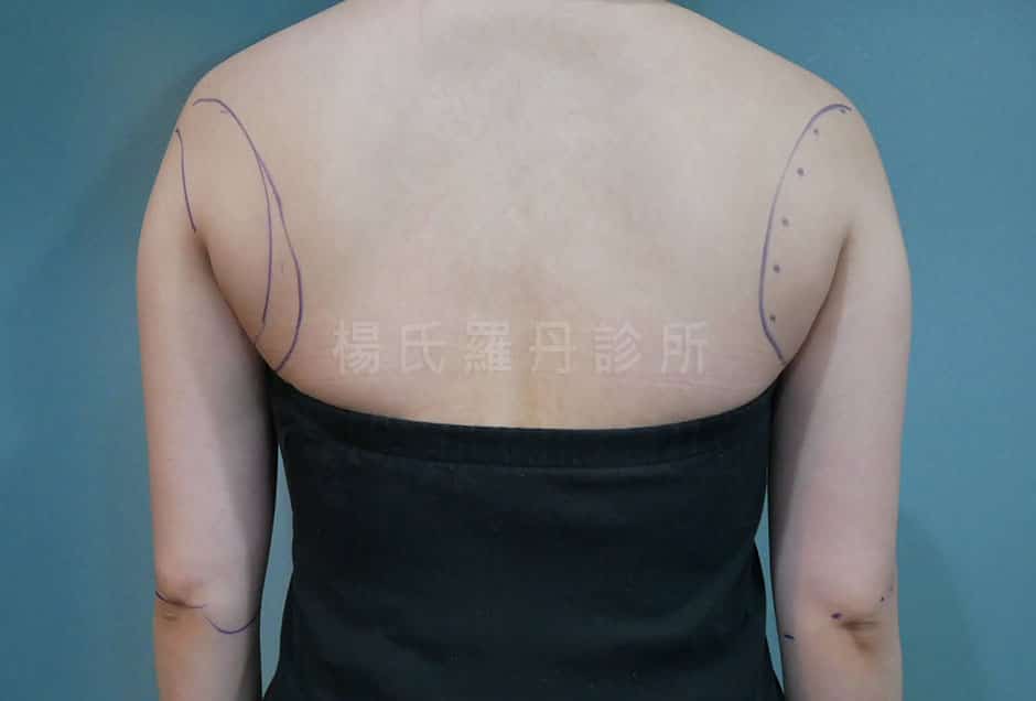 減脂  減脂手術