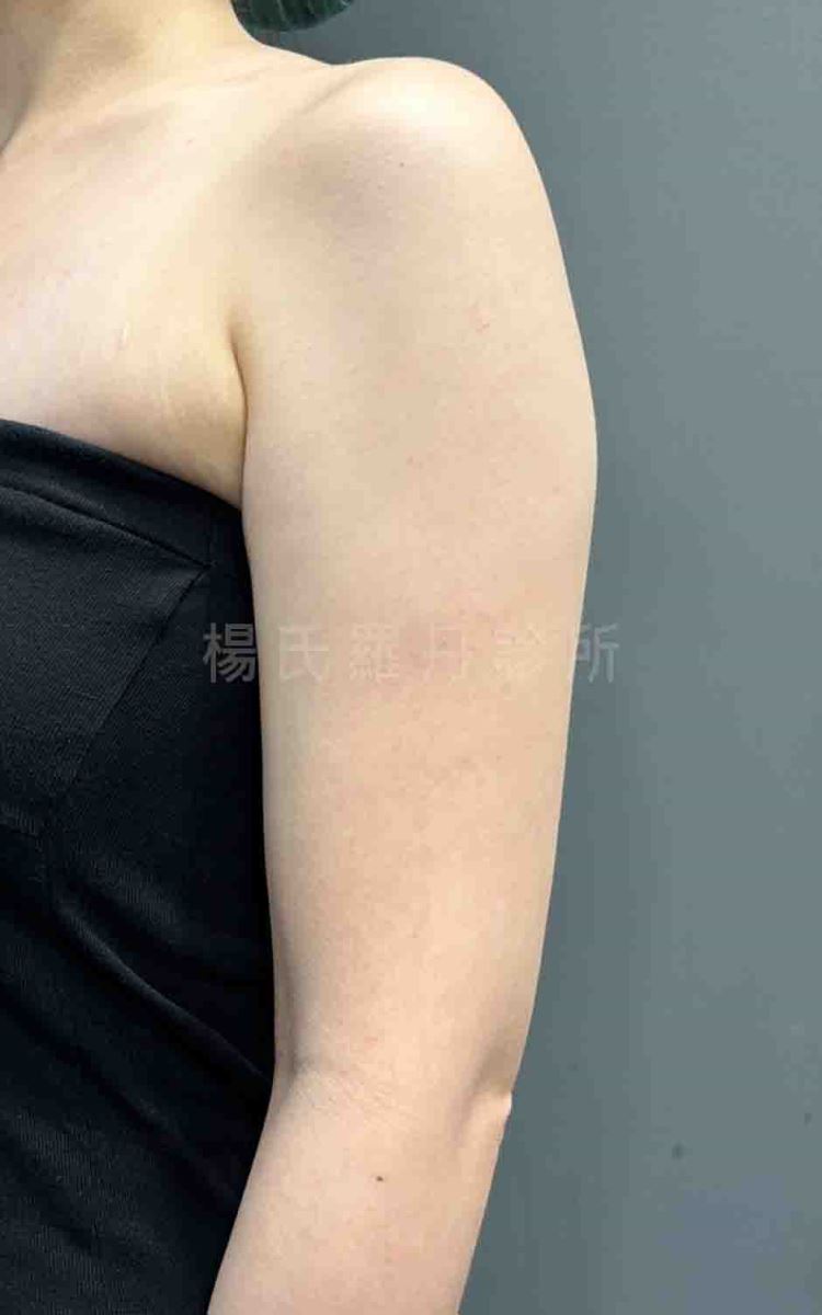 手臂抽脂 抽脂