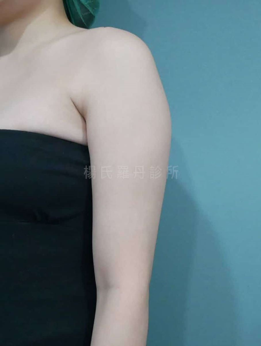 手臂抽脂 抽脂