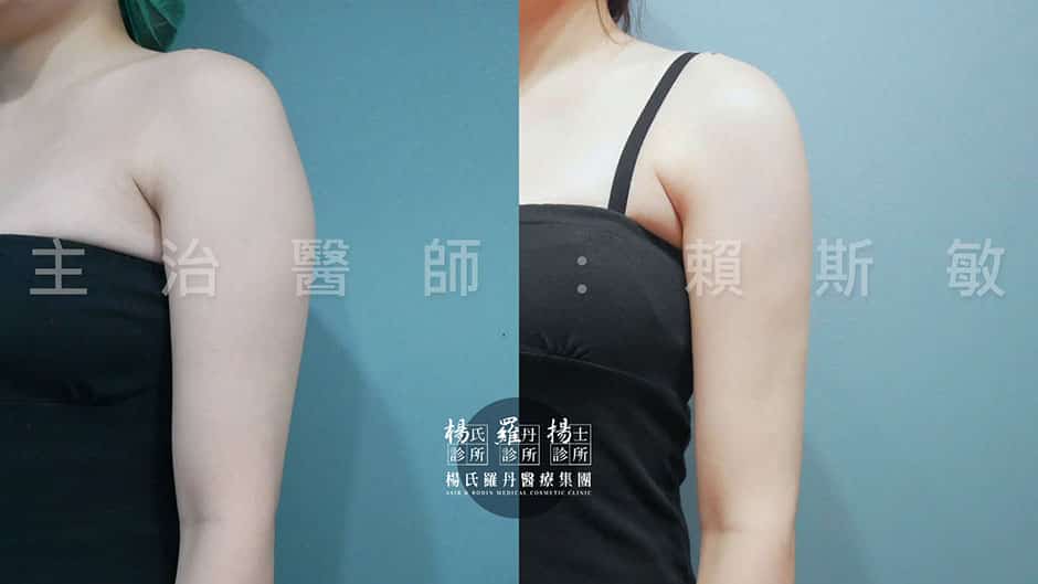 手臂抽脂 雷射減脂 抽脂