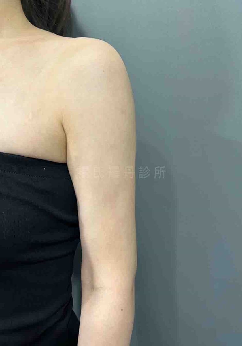 手臂抽脂 瘦手臂