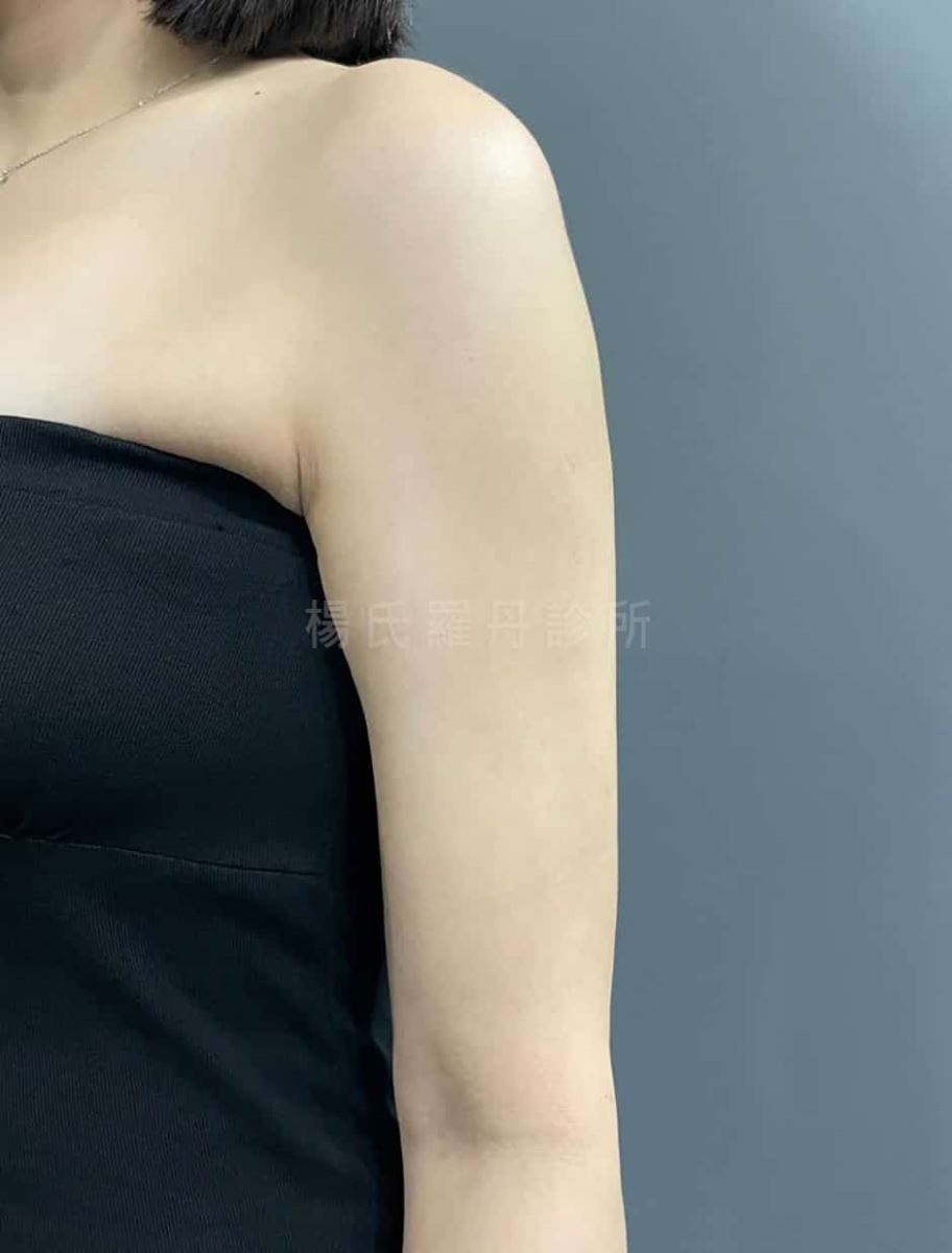 手臂抽脂 瘦手臂