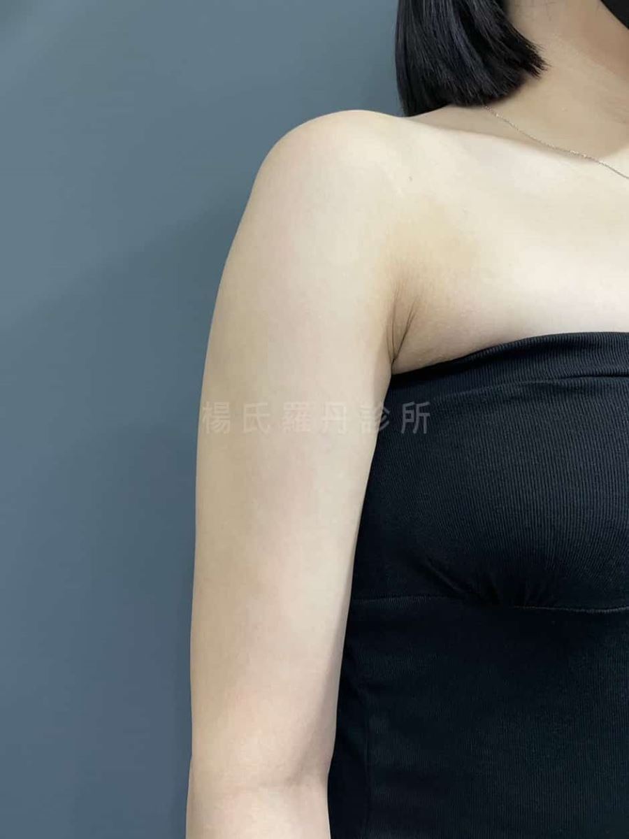 手臂抽脂 雷射減脂