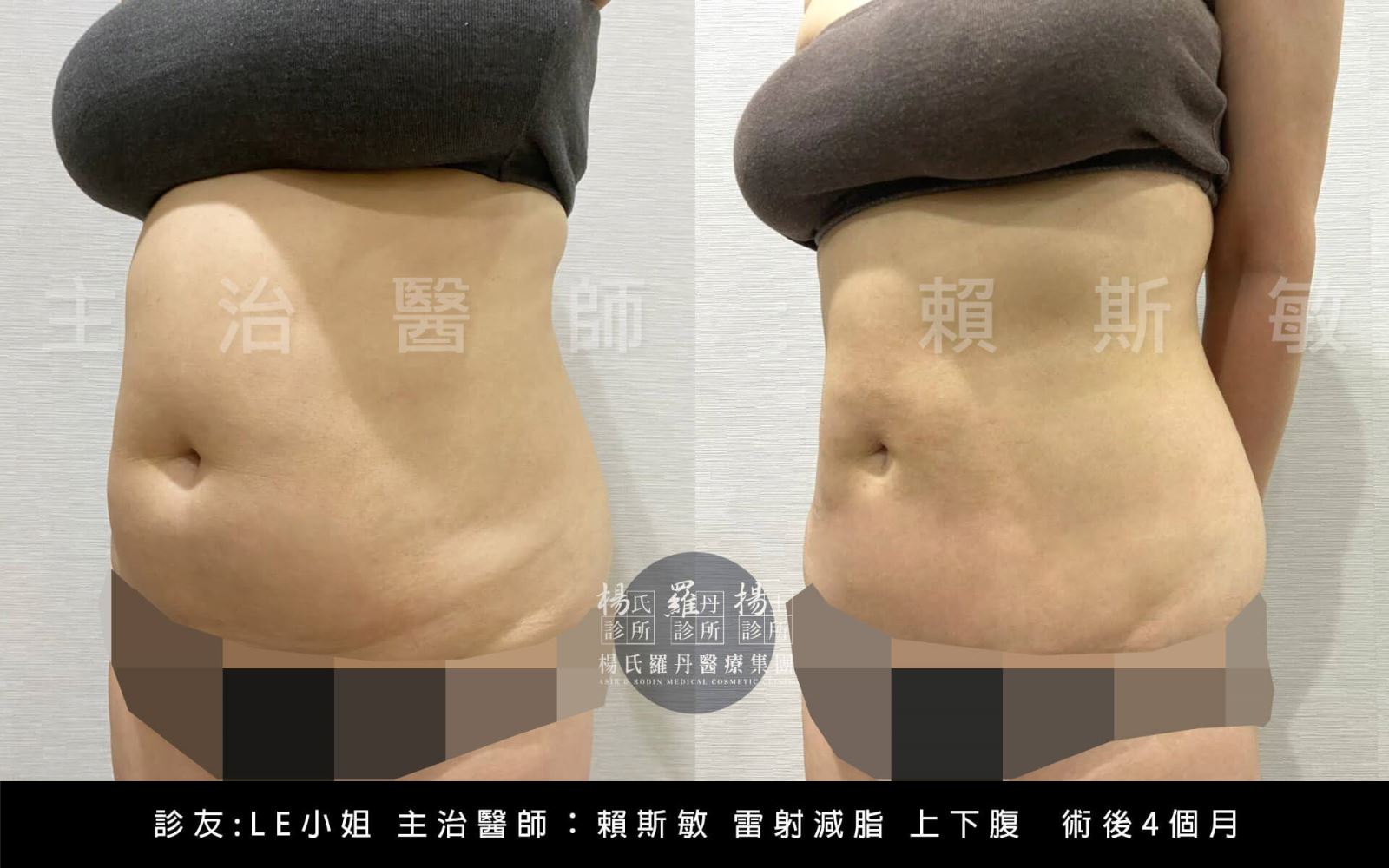 腹部抽脂手術案例