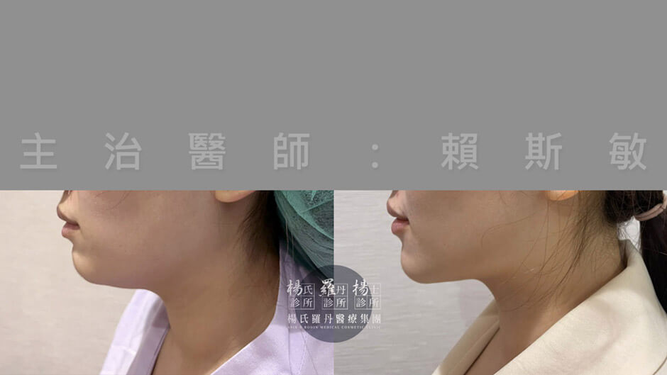 雙下巴抽脂手術案例