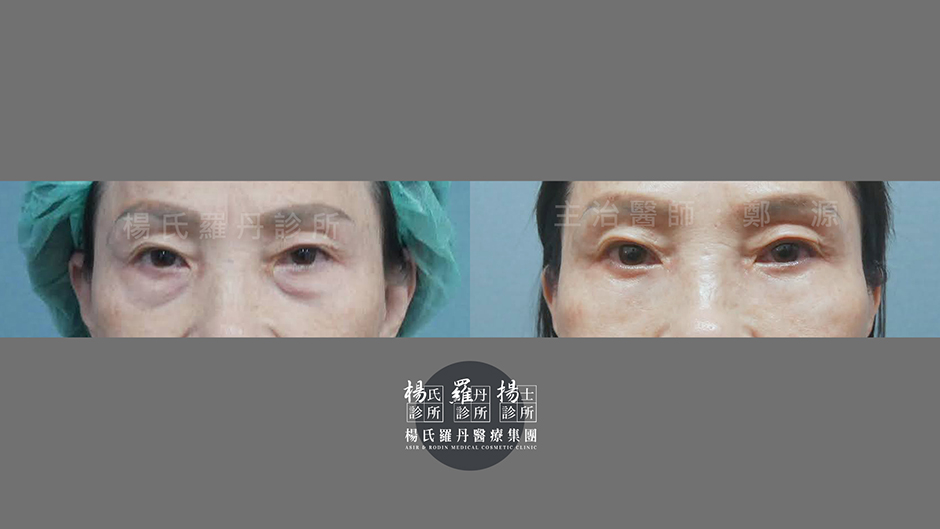 內開眼袋 眼袋 眼袋手術