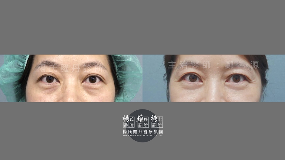 眼袋 內開眼袋 眼袋手術