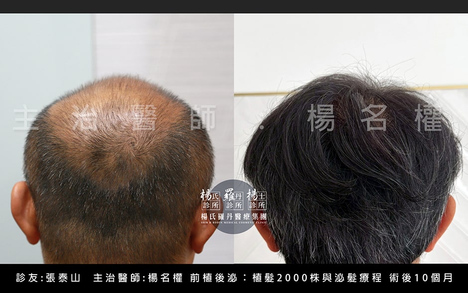 張泰山 植髮 張泰山頭髮