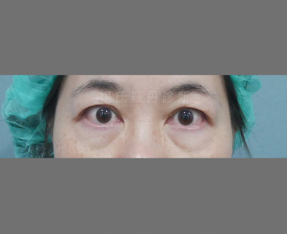 眼袋 眼袋手術