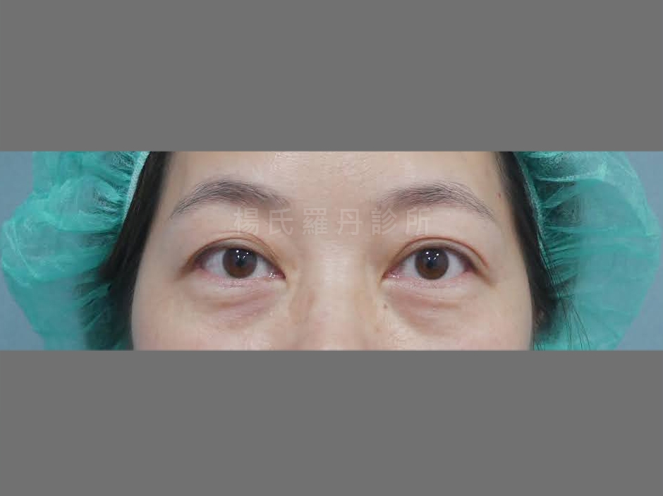 眼袋內開 眼袋