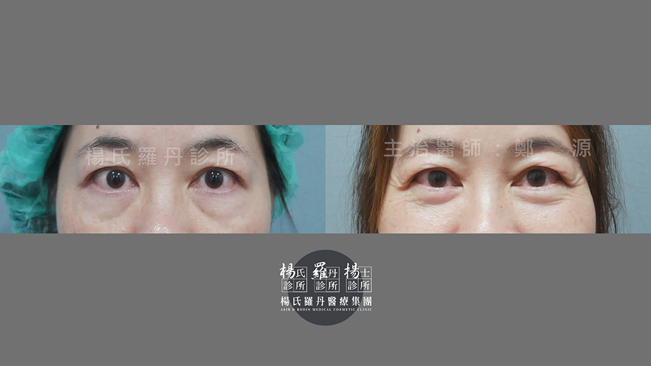 內開眼袋 眼袋 眼袋手術