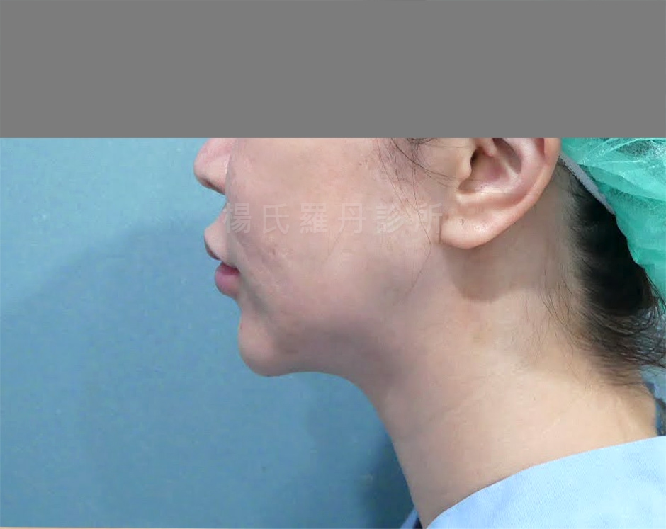 下巴抽脂 雙下巴