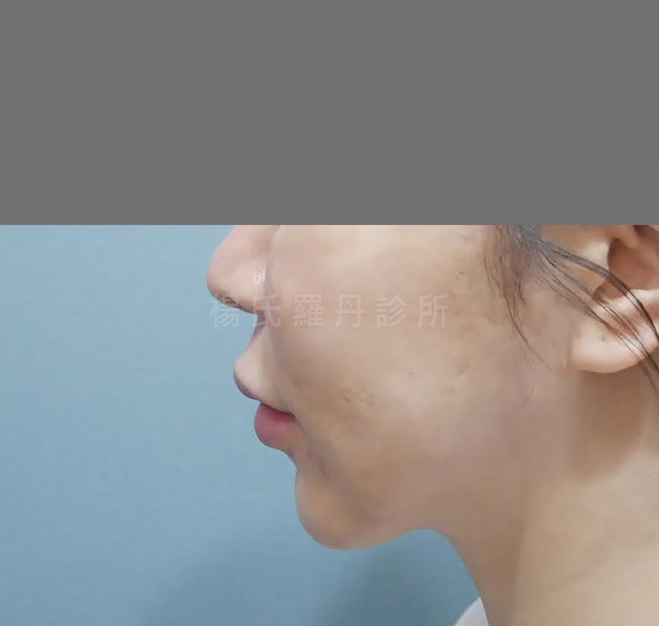 下巴抽脂 抽脂