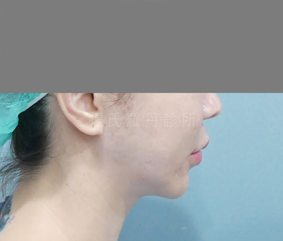 下巴抽脂 雷射減脂
