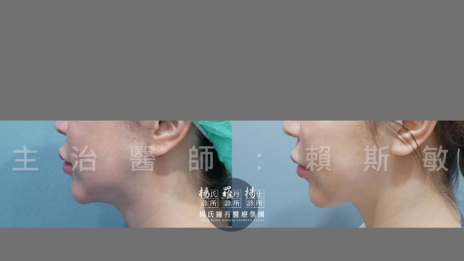 下巴抽脂推薦 下巴抽脂 抽脂