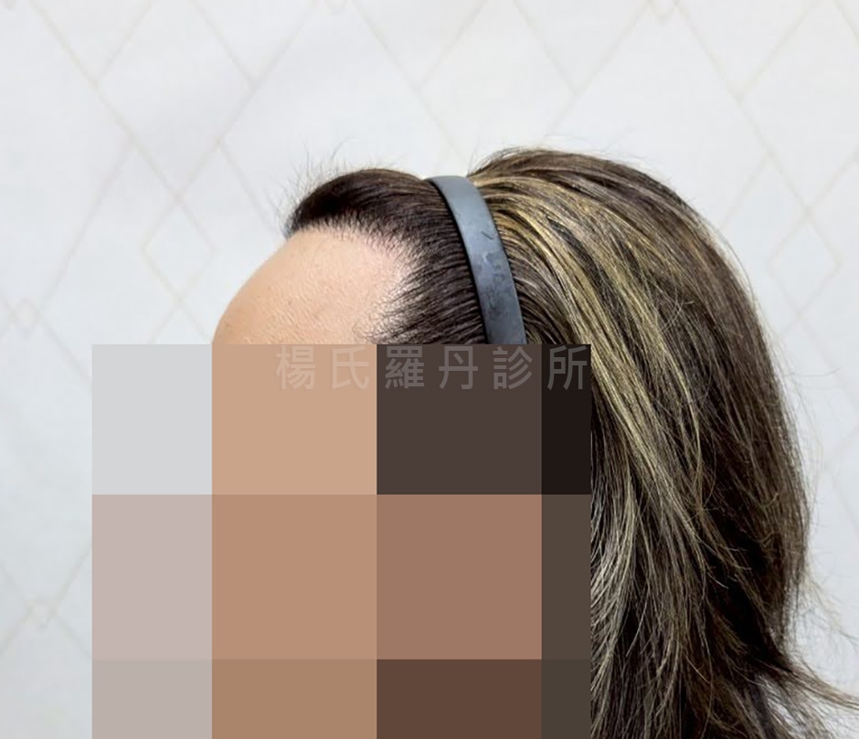 植髮 植髮案例 髮際線