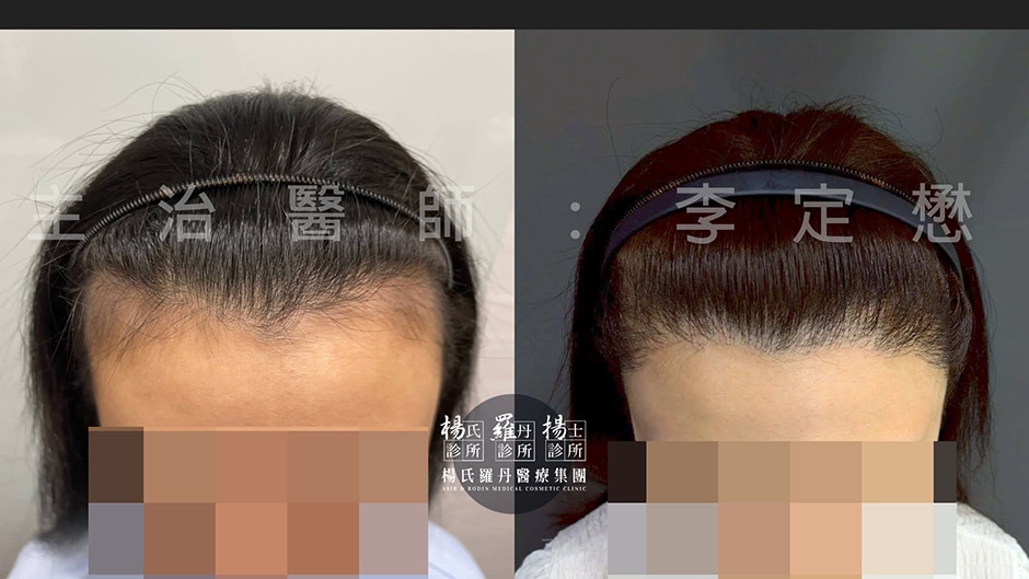 女性植髮案例 女性植髮推薦 植髮