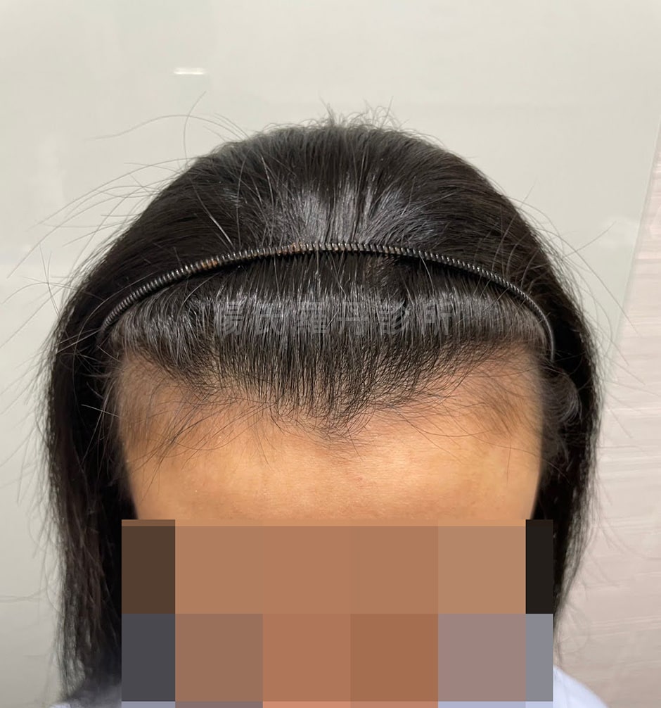 女性植髮 台北女性植髮