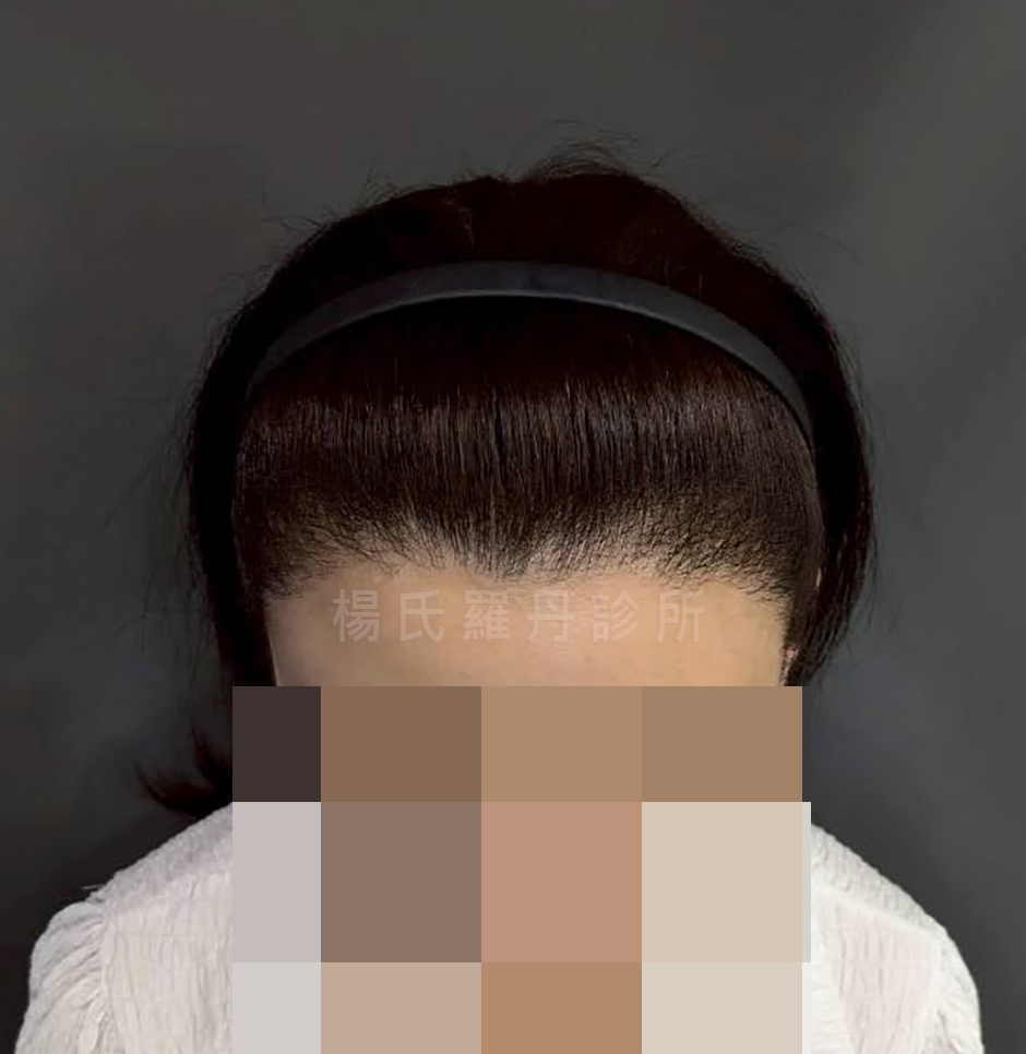 台北美型植髮 美型植髮