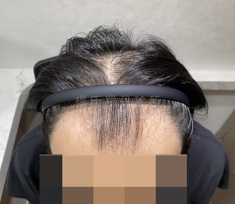 植髮 植髮案例