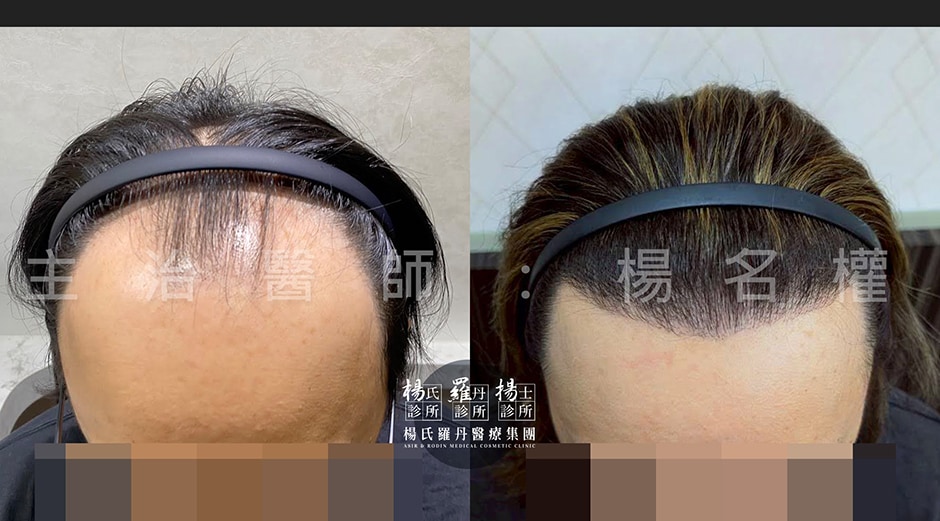 植髮 植髮案例 植髮推薦