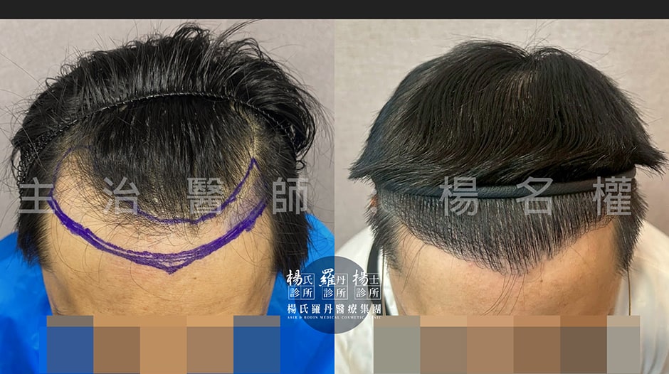 植髮 植髮推薦 台北植髮推薦