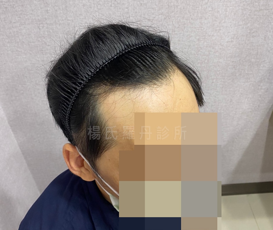 植髮 落髮