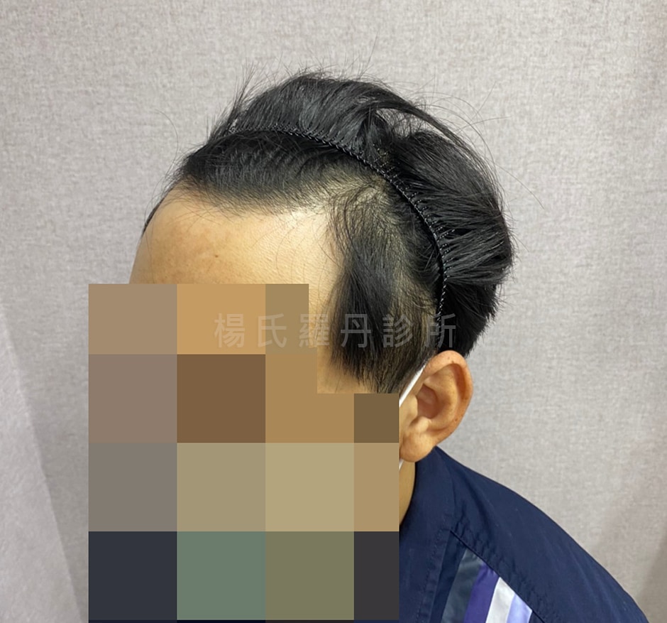 植髮 植髮手術