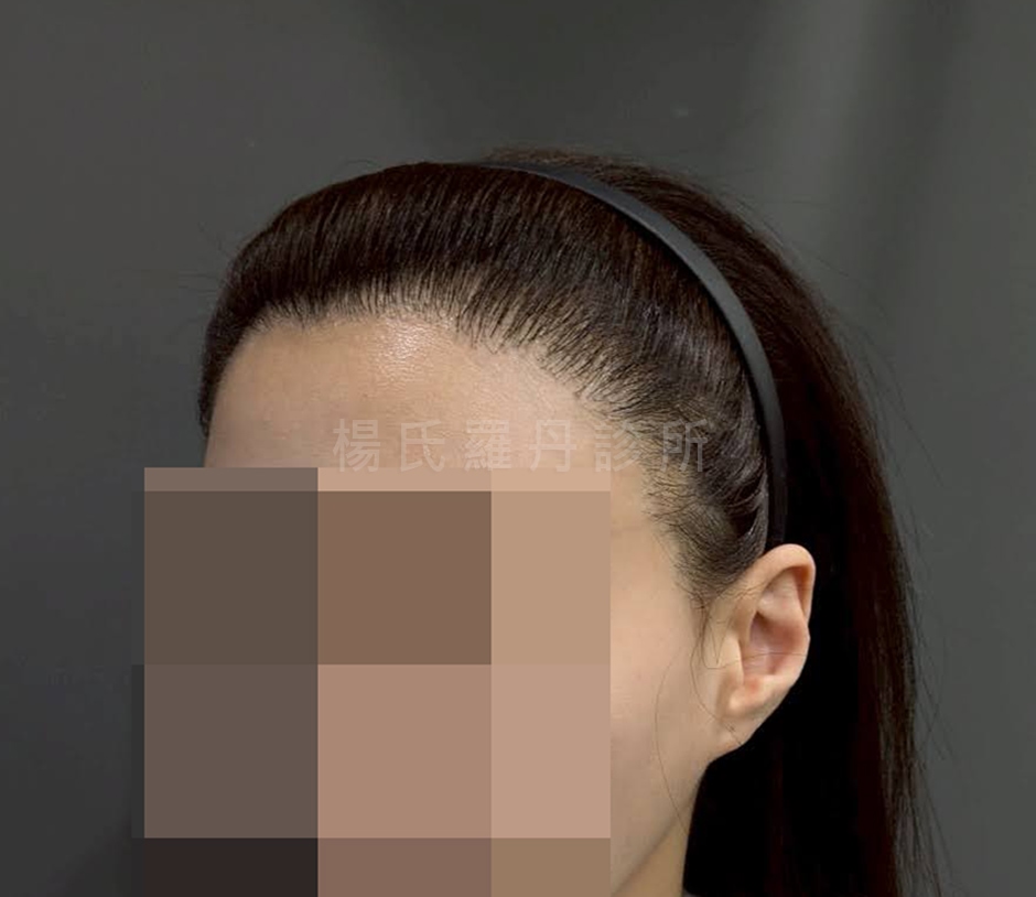 女性植髮 植髮手術