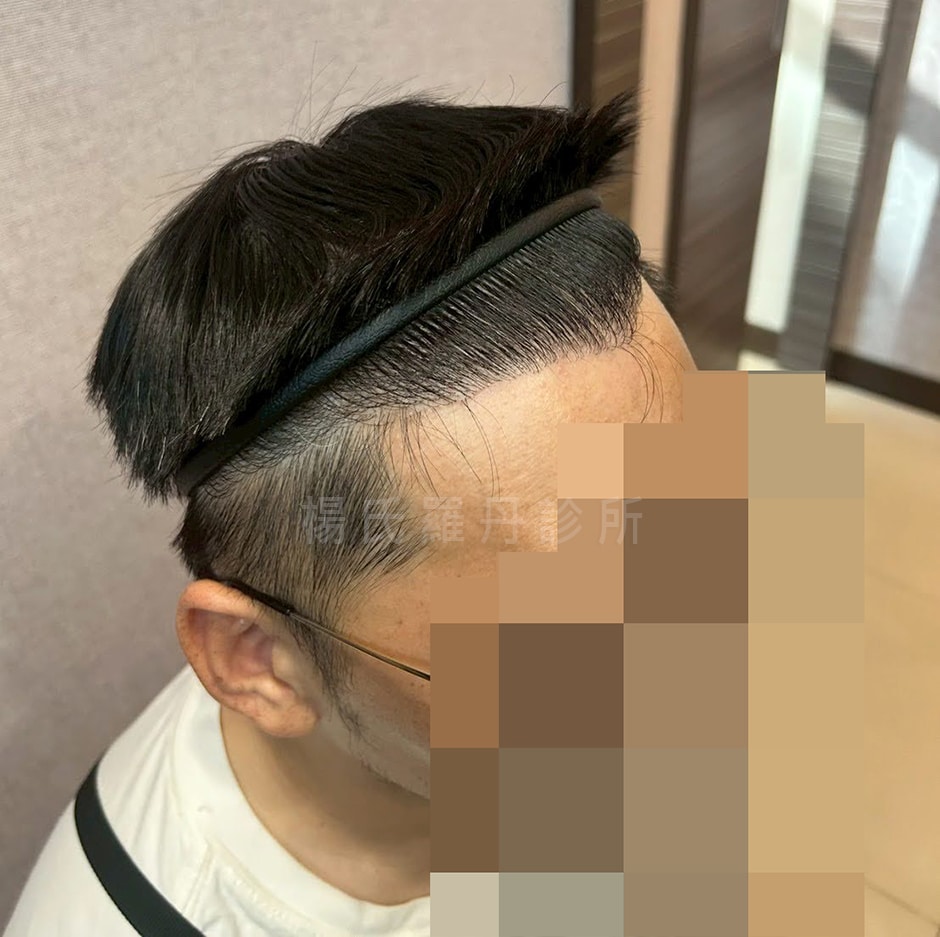 植髮 禿髮