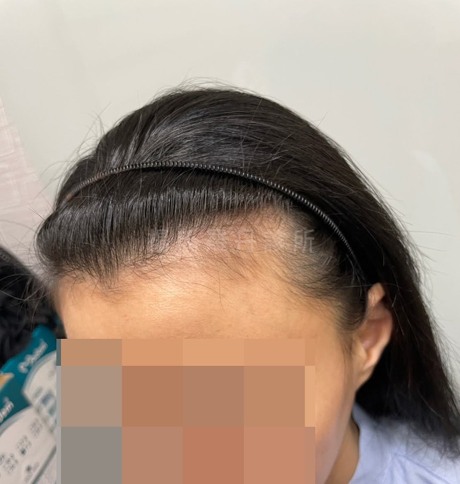 植髮成果 髮際線