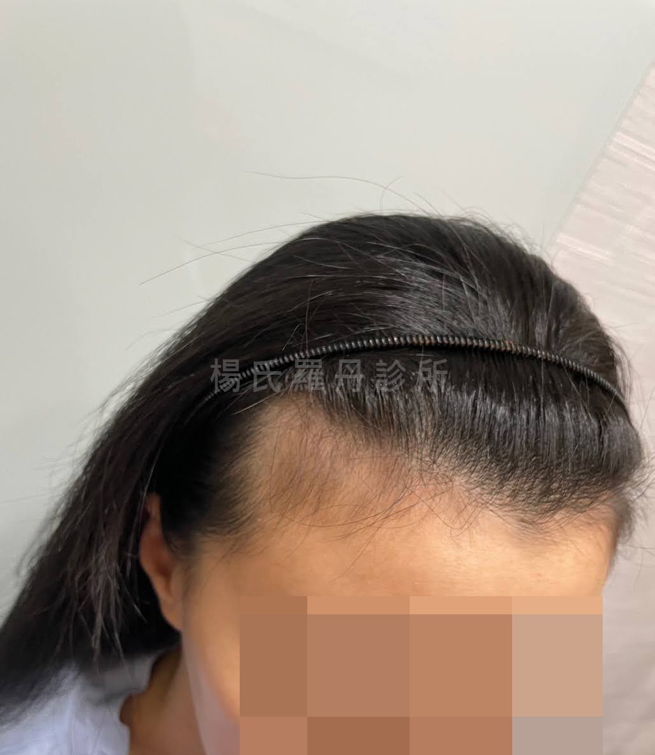 女性髮際線植髮 女性髮際線植髮推薦