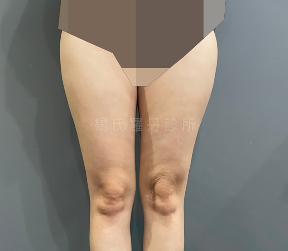 大腿抽脂 抽脂