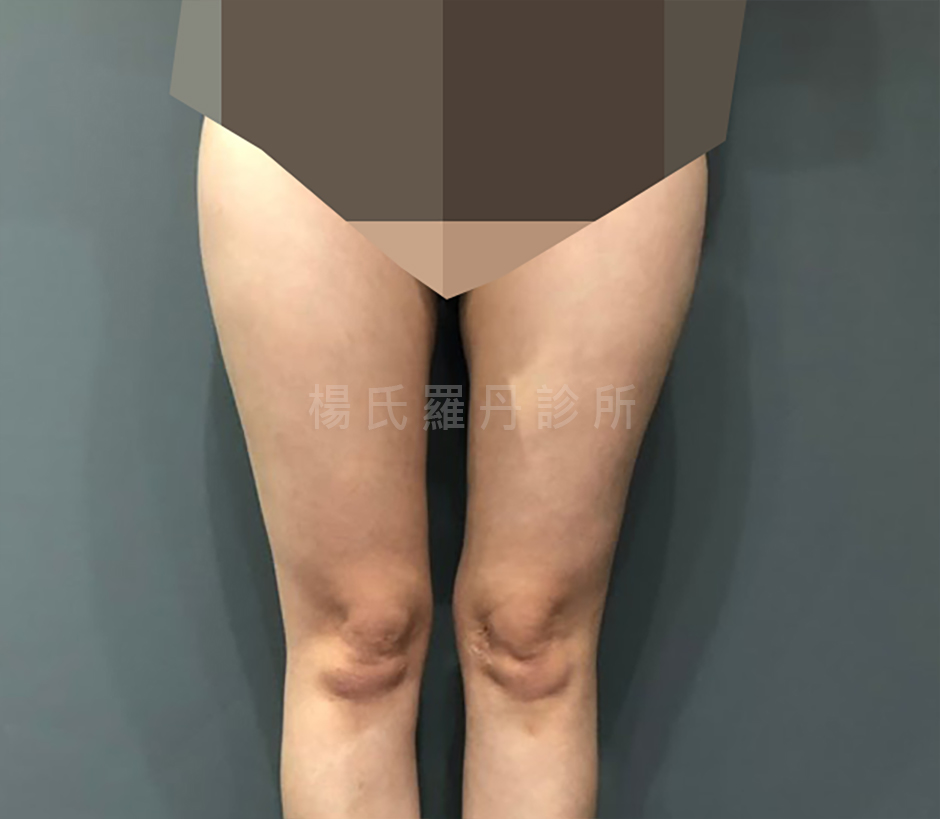 大腿抽脂 瘦大腿