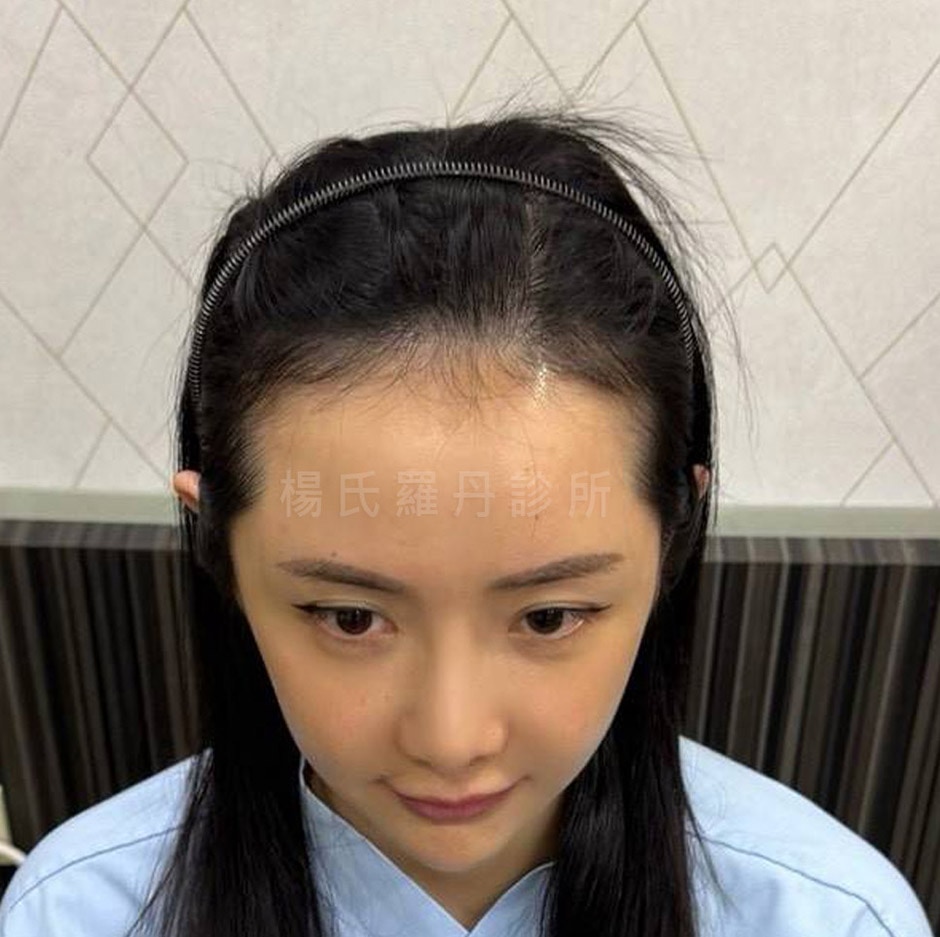 女性植髮 髮際線