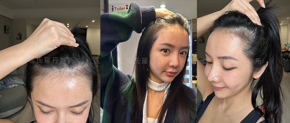 女性植髮 言言 髮際線植髮