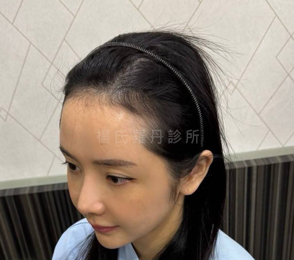 美型髮際線 案例