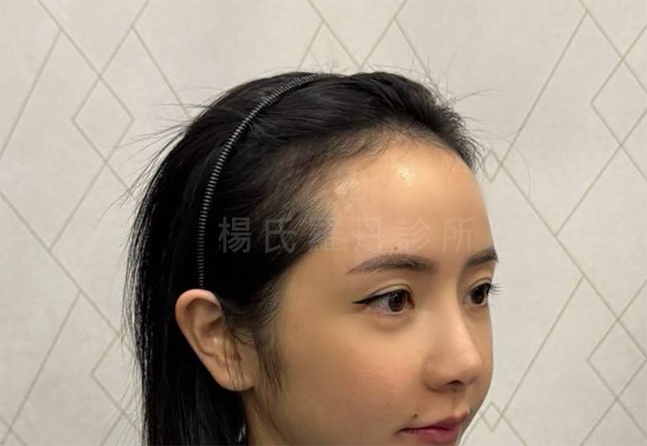 髮際線 下移效果 植髮手術