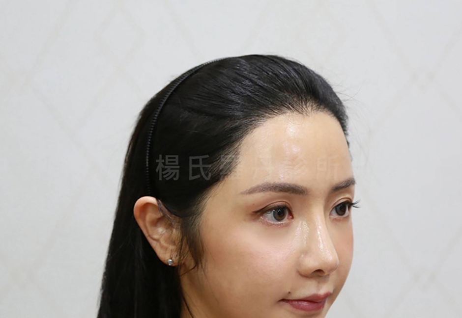 女性植髮 微創植髮