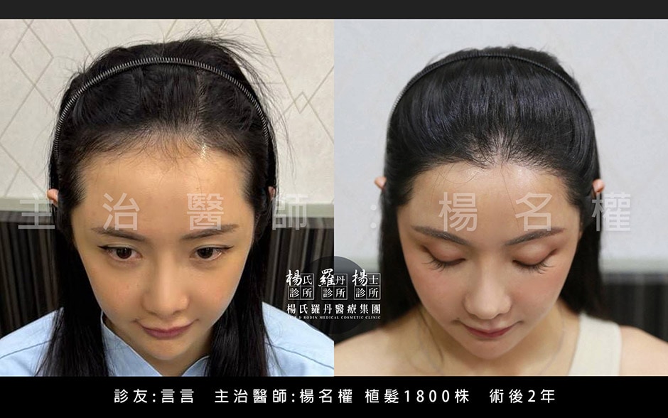 女性植髮 言言 髮際線設計 術後
