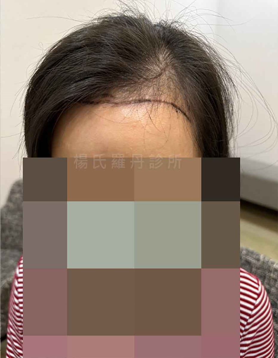 女性額角空洞與毛囊萎縮術前照