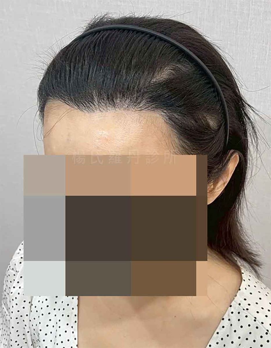 美型植髮術後髮流自然生長照