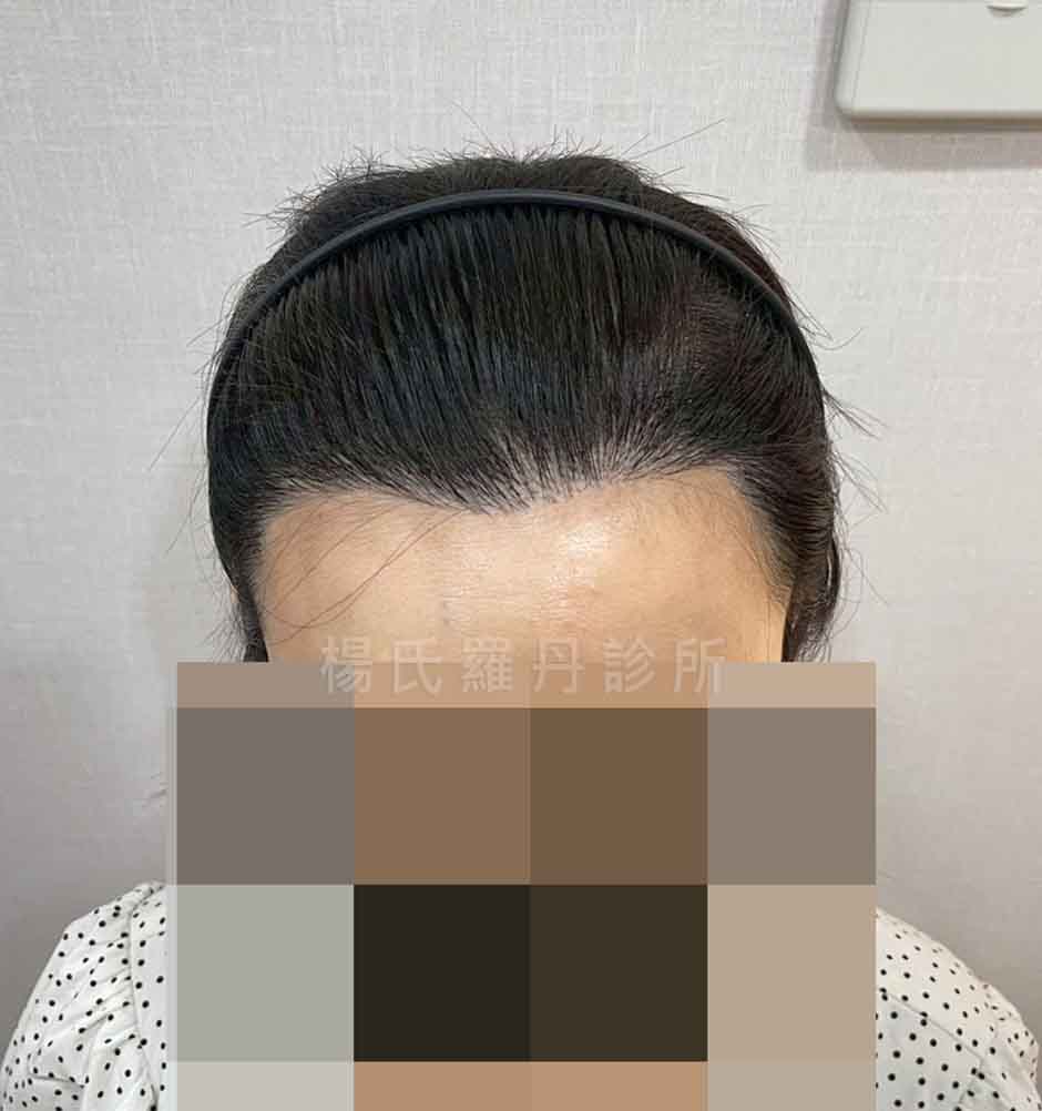 女性美形髮際線植髮術後自然成果照