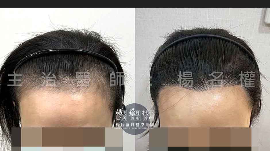 女性髮際線植髮手術前與術後兩年成果對比圖