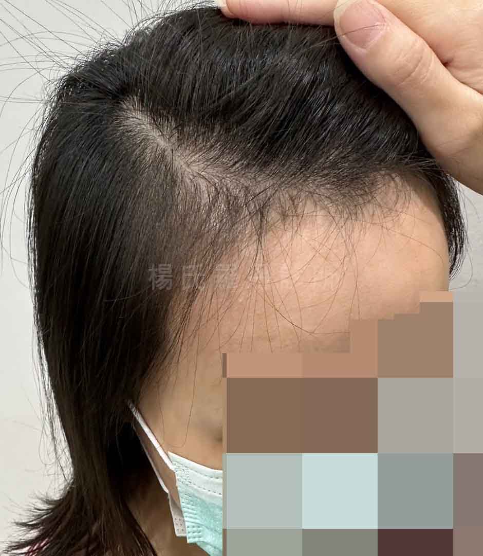 女性分線稀疏與頭頂落髮術前狀態