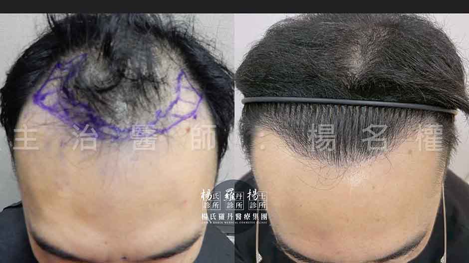 微創植髮術前與術後四年對比紀錄照