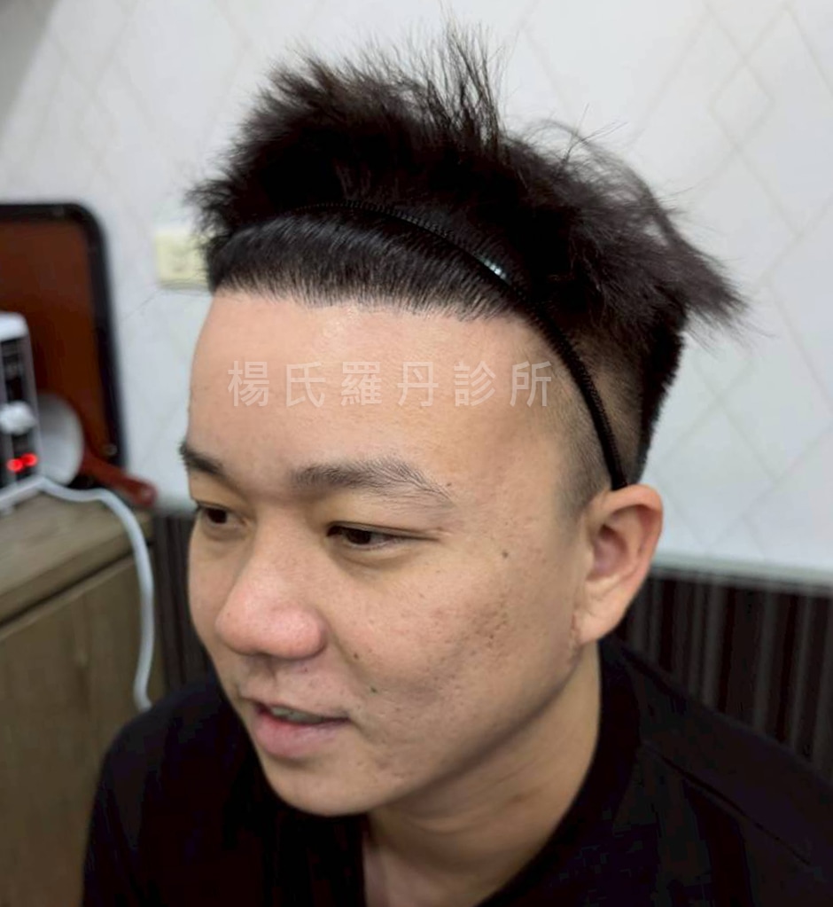 微創植髮術後髮量加密照