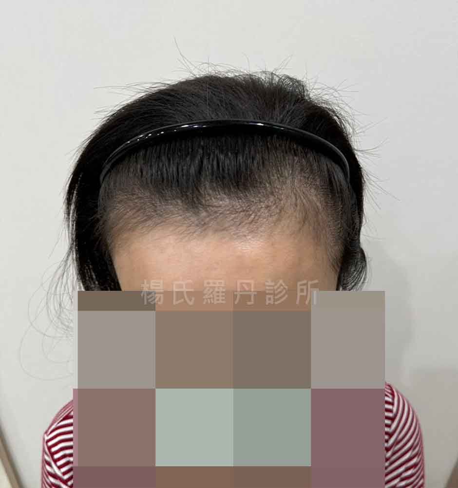 女性髮際線後退與高額頭術前紀錄照